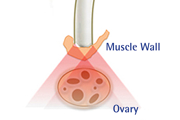 Engineering Earlier Ovarian Cancer Detection.