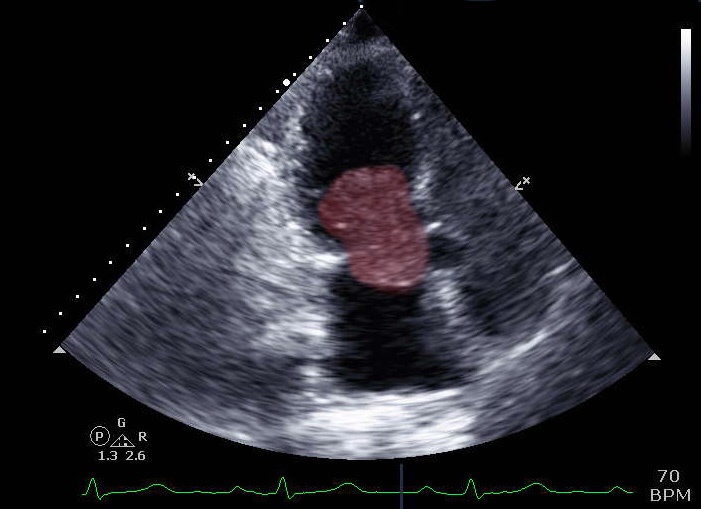 Image of Marcia Cox's heart prior to surgery shows a tennis ball sized tumor originating in her heart's left atrium and growing into the heart's left ventricle. (UConn Health Photo)