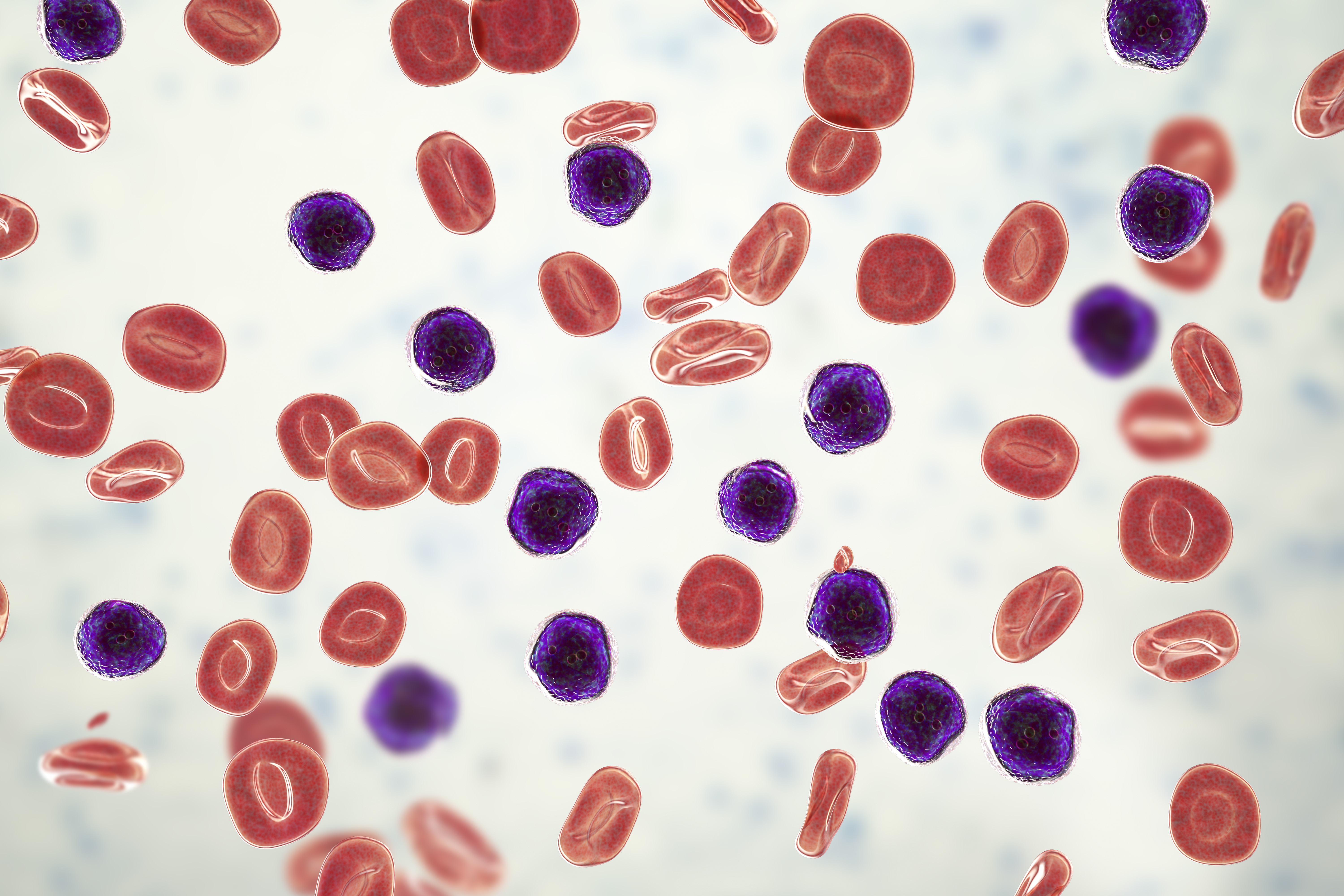 Acute lymphoblastic leukaemia. Computer illustration showing abundant lymphoblast cells in human blood.