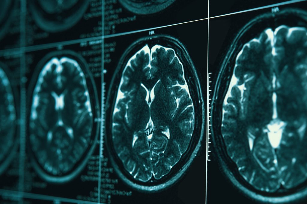 MRI scans of a human brain